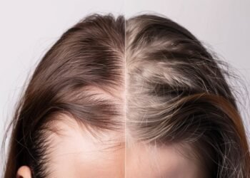 Caida de cabello